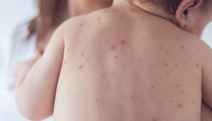 measles cases in mumbai